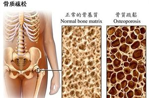 骨質疏松
